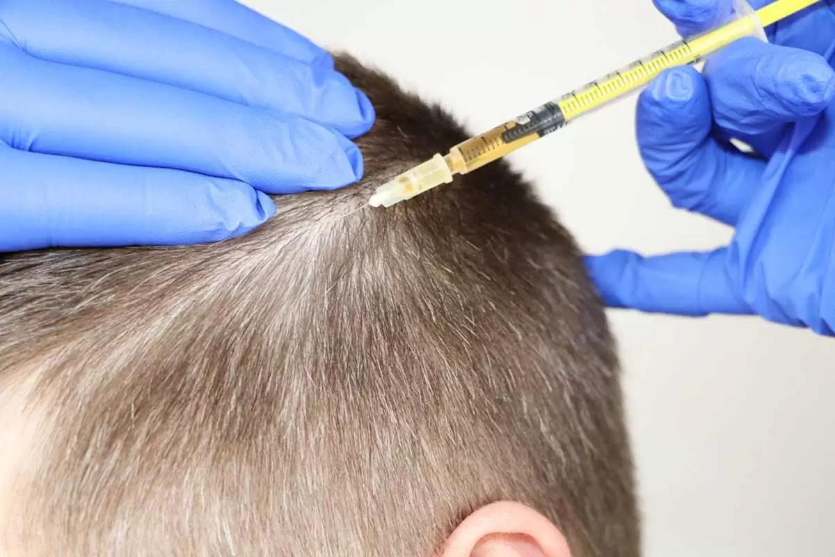 علاج الميزوثيرابي للشعر