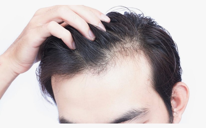 تقنية الريجينيرا لتكثيف الشعر وعلاج التساقط