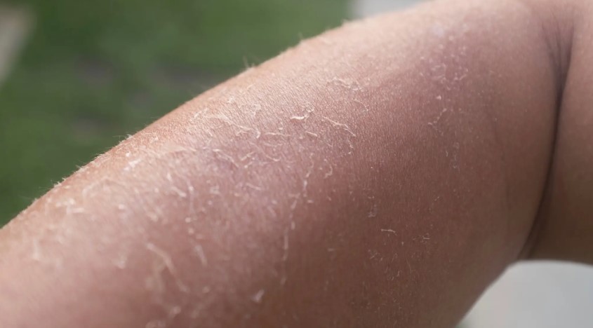 جفاف الجلد والحكة