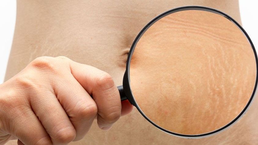كيفية التخلص من علامات تمدد الجلد