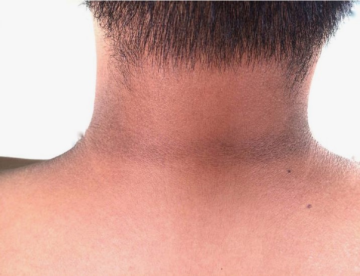 مناطق التصبغ في الوجه والجسم