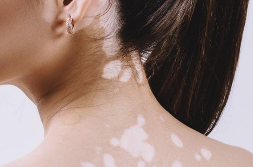 مناطق التصبغ في الوجه والجسم