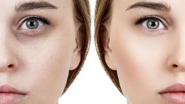 علاج التصبغات بالترانيكساميك