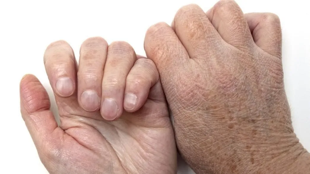 علاج تجاعيد اليدين