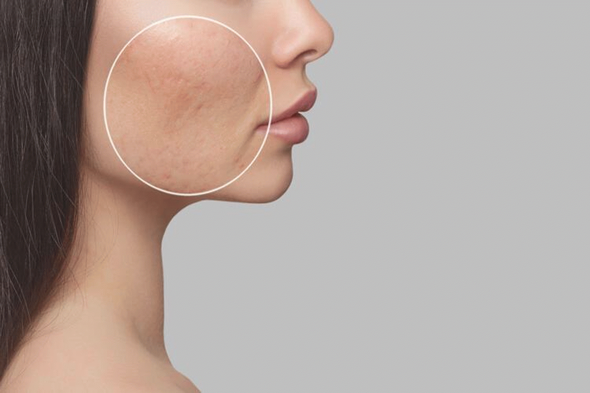 جلسات subcision