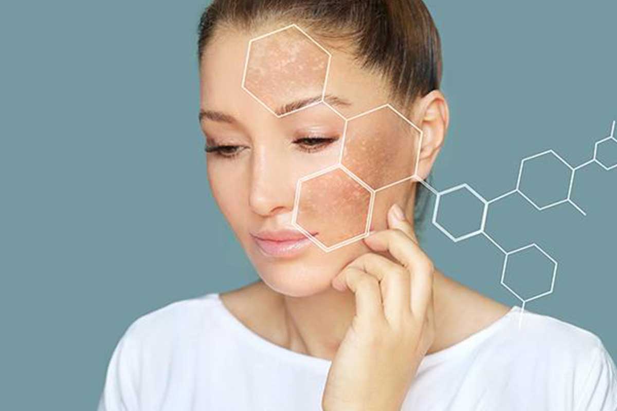 علاج الكلف والتصبغات العميقة