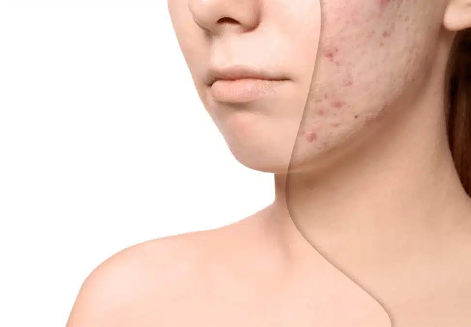 طرق علاج الندبات العميقة في الوجه