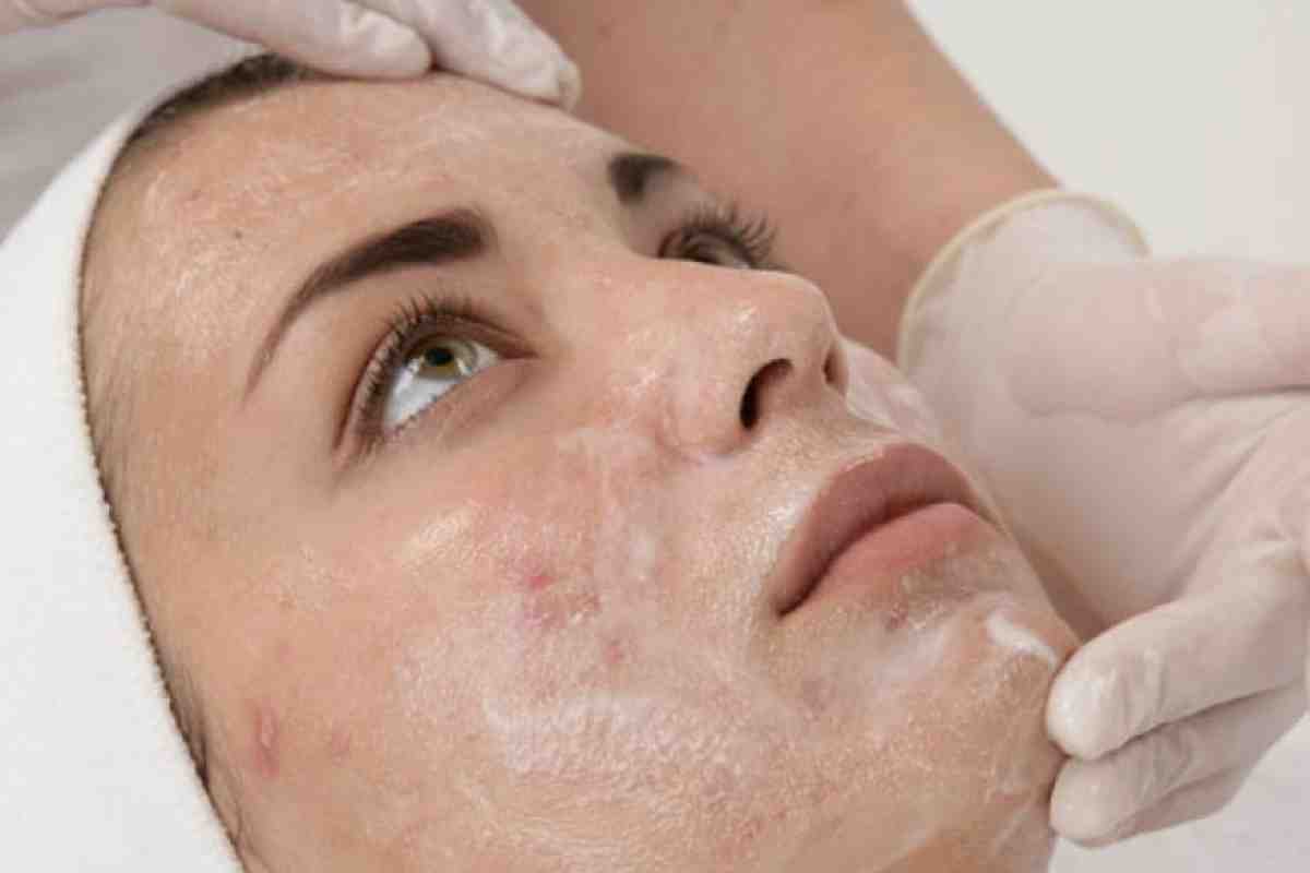 تقشير كيميائي لندبات حب الشباب
