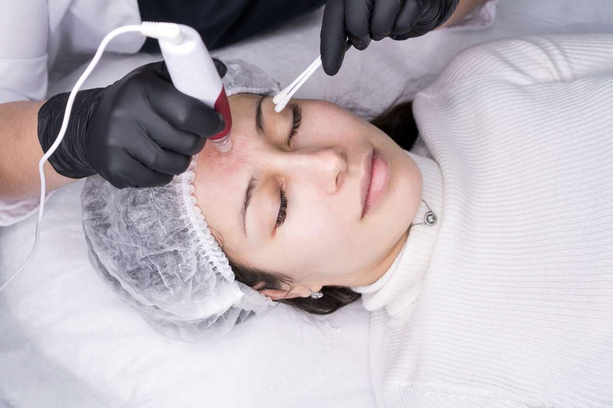 microneedling