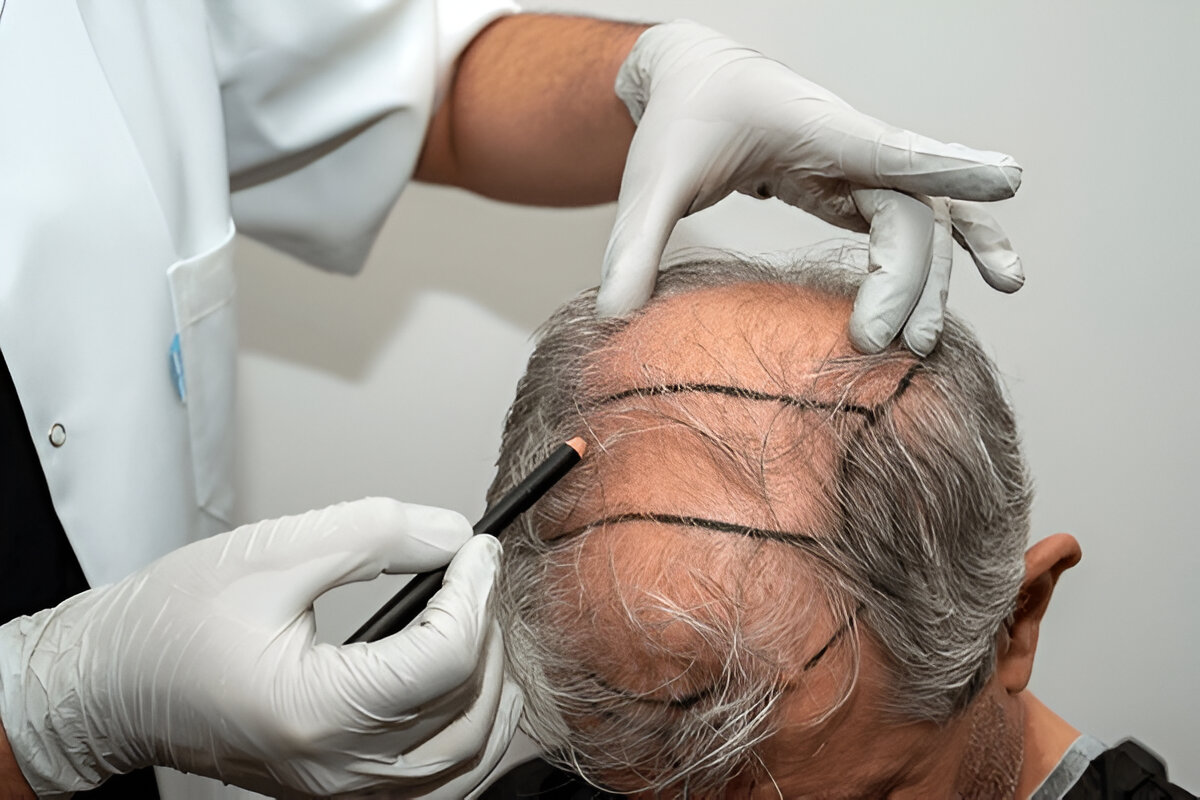 كثافة الشعر بعد زراعة الشعر