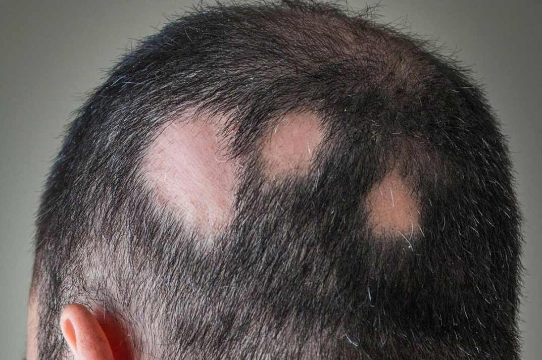 علاجات الثعلبة الحديثة Jak Inhibitors