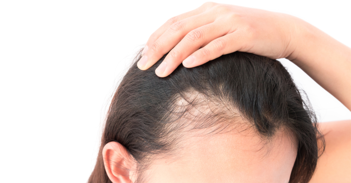 علاج الصلع الوراثي