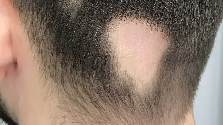 علاجات الثعلبة الحديثة Jak Inhibitors