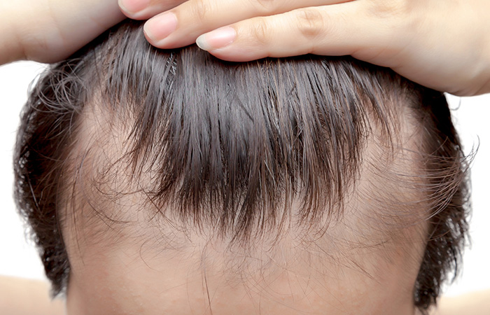 علاج الصلع الوراثي