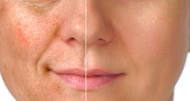 علاج التصبغات للبشرة