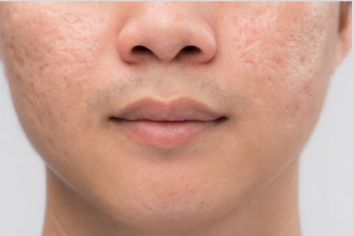 أفضل طرق علاج ندبات حب الشباب