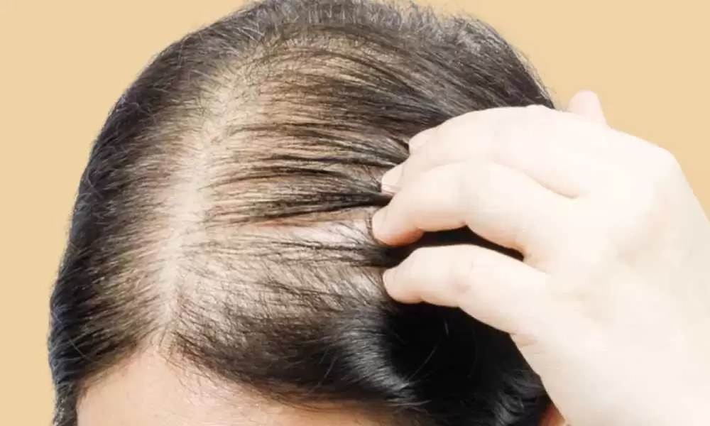 ما هو فيناسترايد