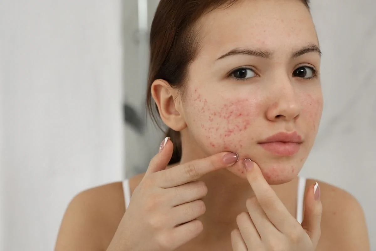 أفضل طرق علاج ندبات حب الشباب