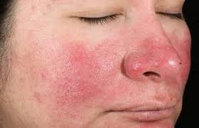 أسباب احمرار الوجه