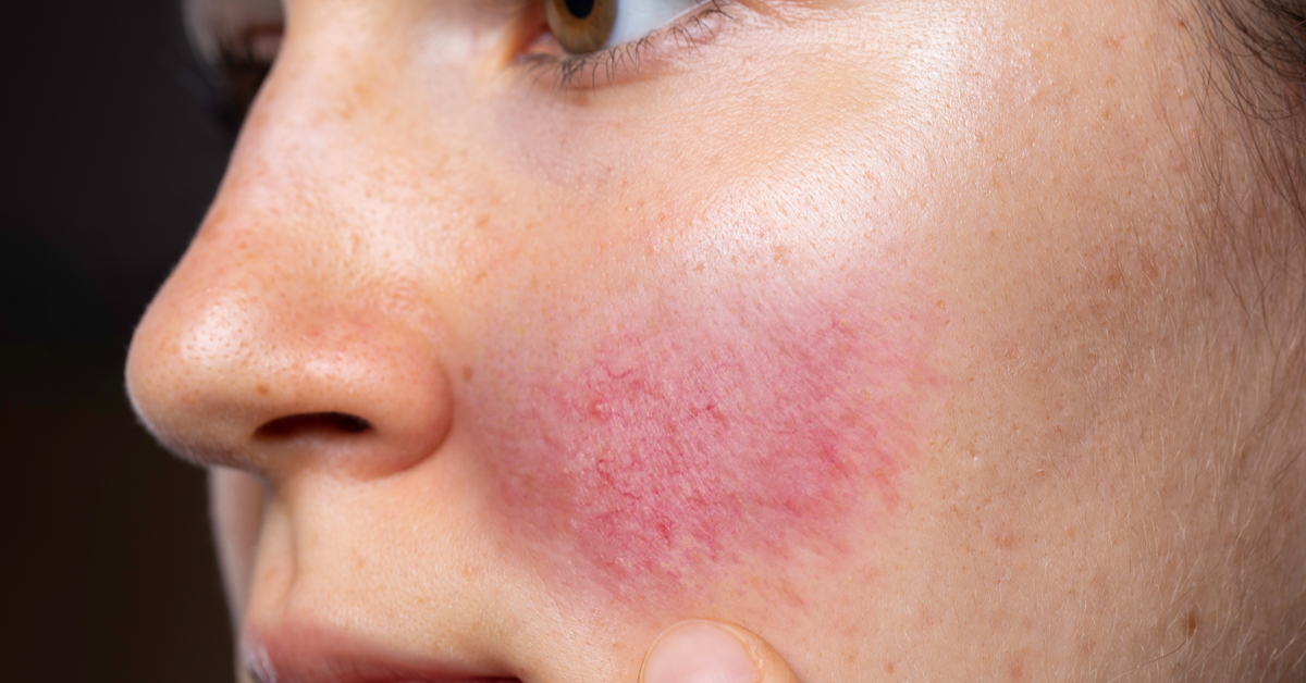 أسباب احمرار الوجه