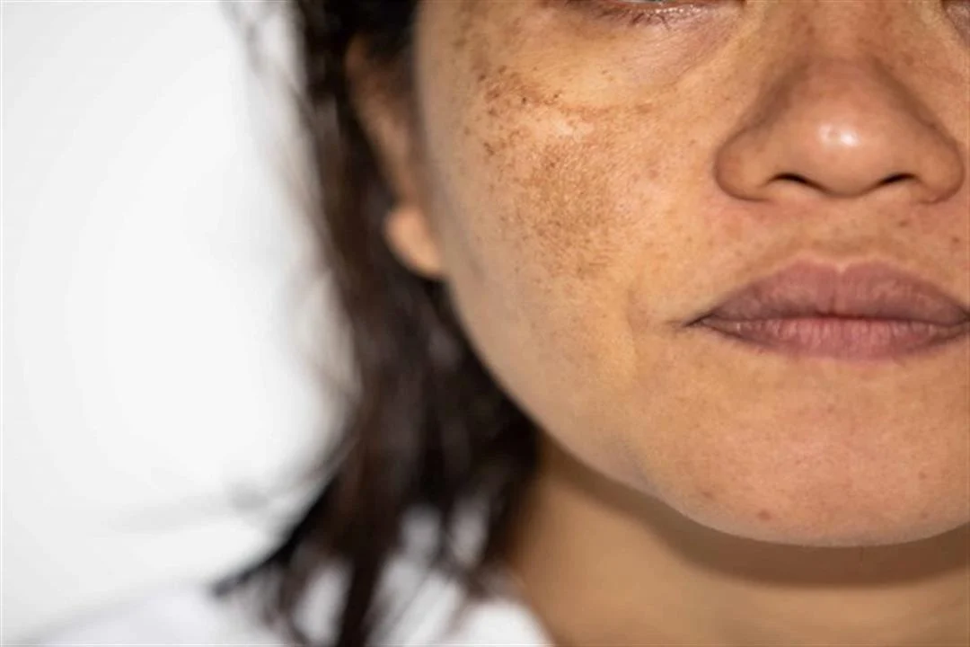 أسباب اسمرار البشرة