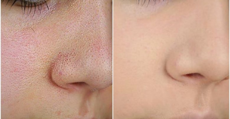 أسباب المسام الواسعة في الوجه