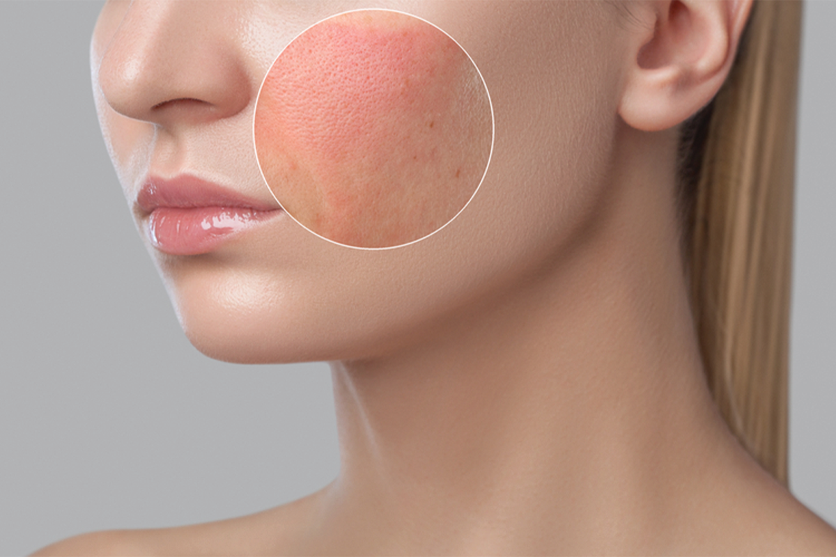 أسباب المسام الواسعة في الوجه