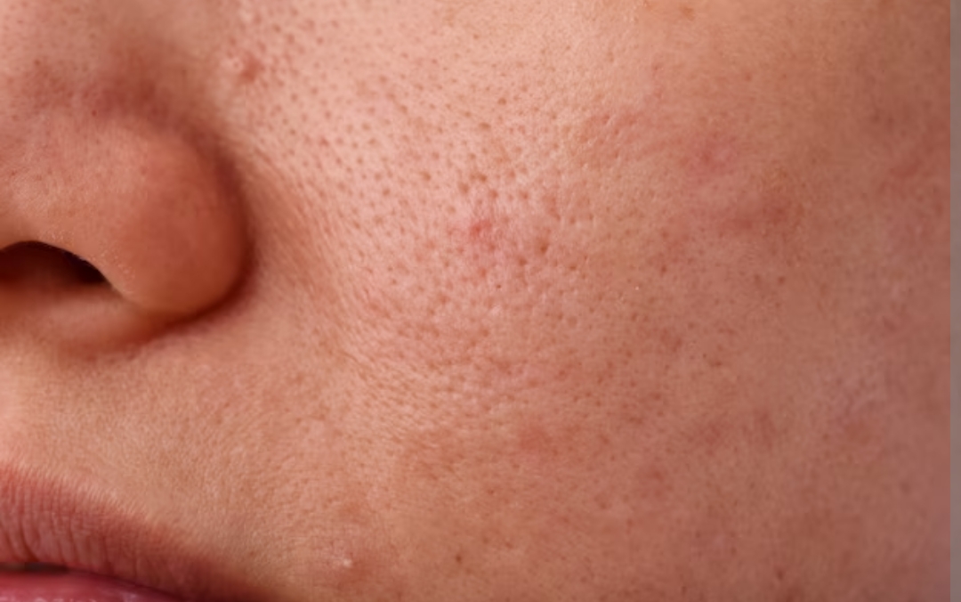 أسباب المسام الواسعة في الوجه