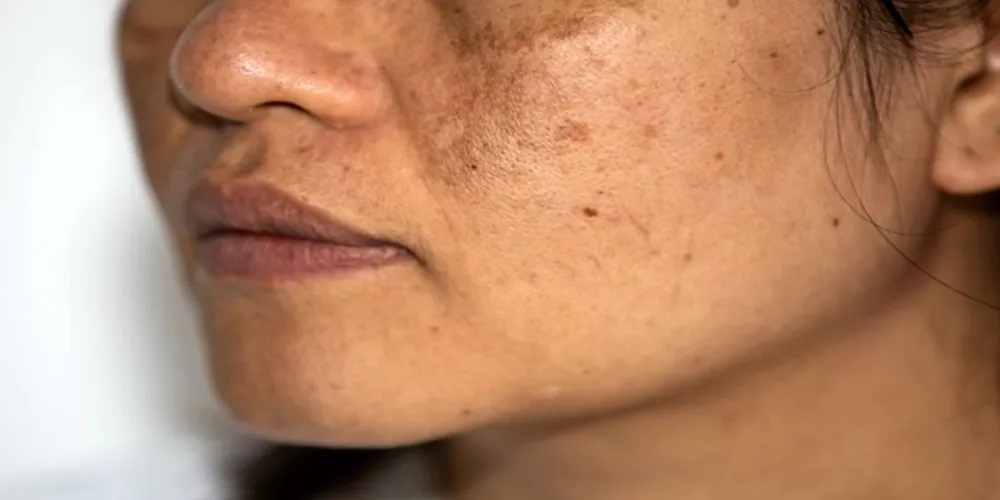 أسباب ظهور الكلف