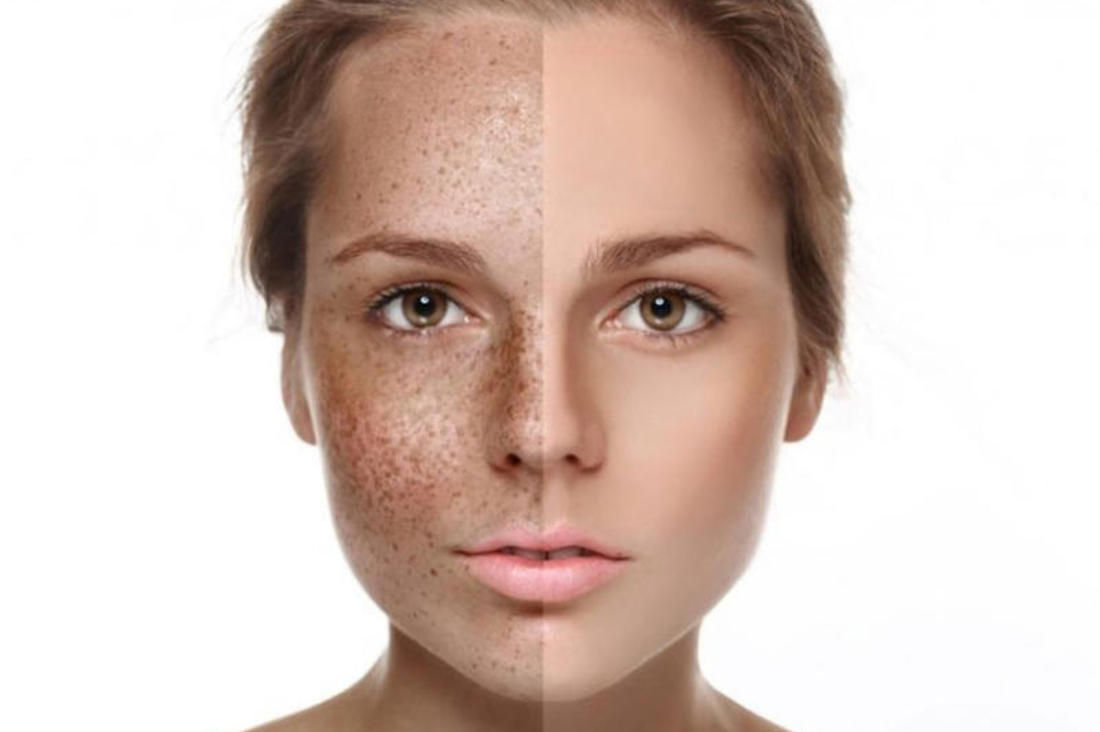 أسباب ظهور الكلف