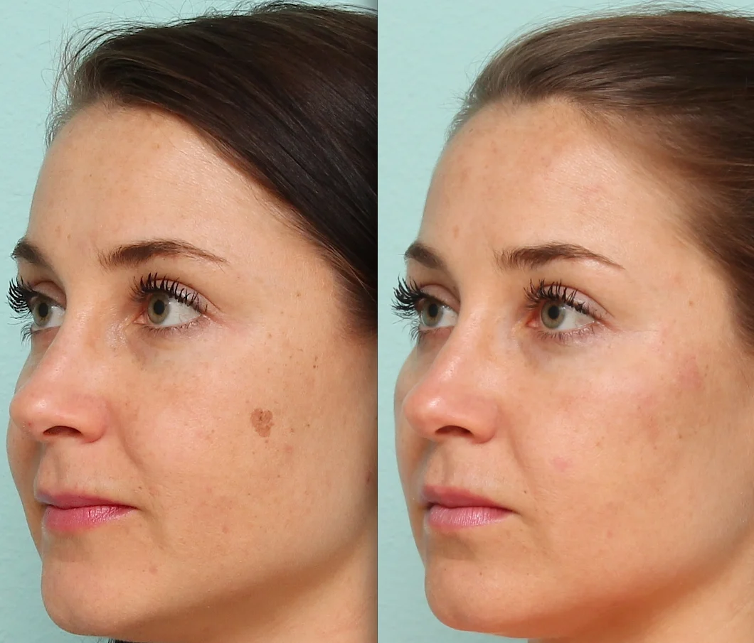 أضرار الليزر للبشرة