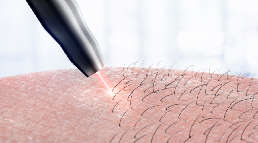 إزالة الشعر بالليزر للمناطق الحساسة