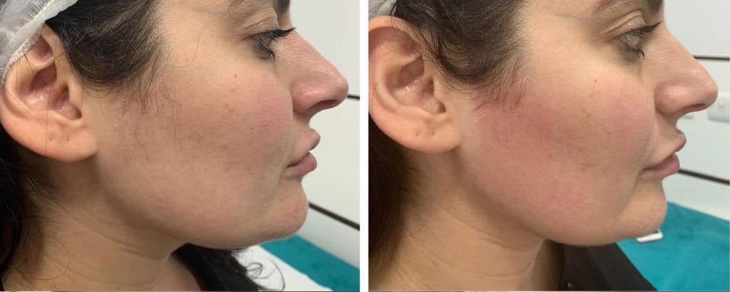 إزالة الشعر بالليزر للوجه