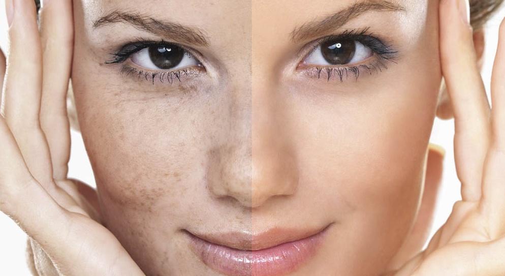 علاج التصبغات في الوجه