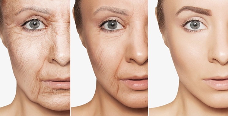 بوتكس علاج تجاعيد العين