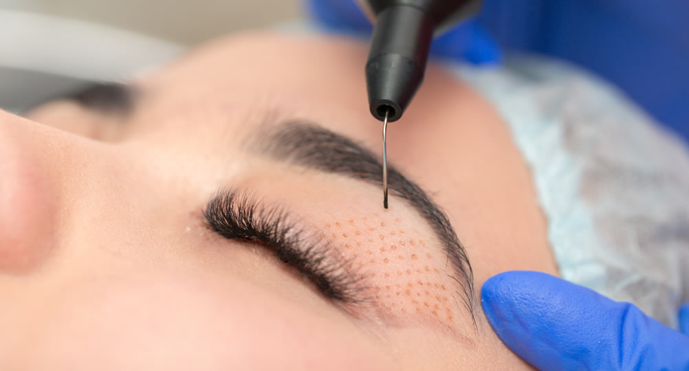 شد الجفون بدون جراحة