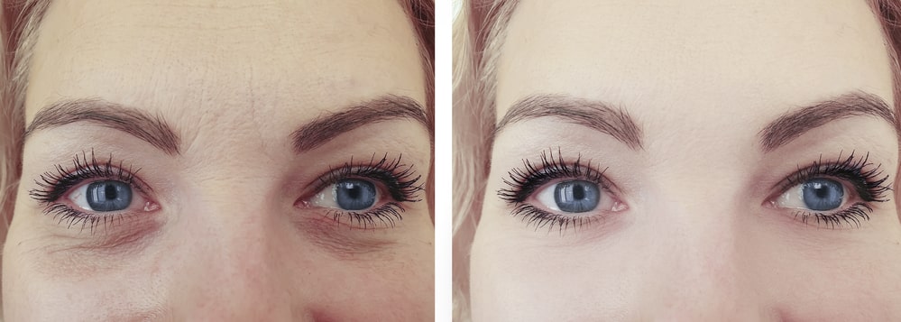 شد الجفون بدون جراحة