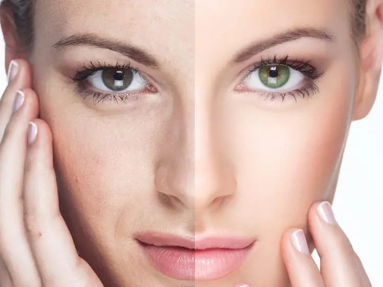 طرق تفتيح البشرة طبياً