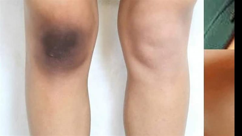 علاج اسمرار الركب