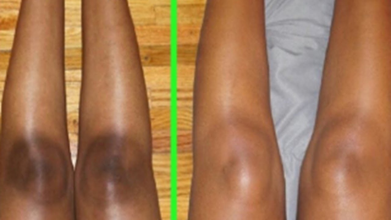 علاج اسمرار الركب