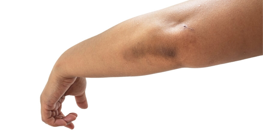 علاج اسمرار الكوع