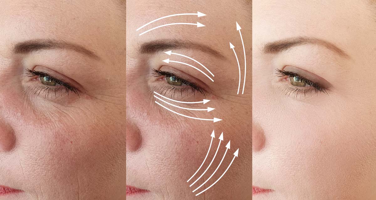 علاج التجاعيد بدون جراحة