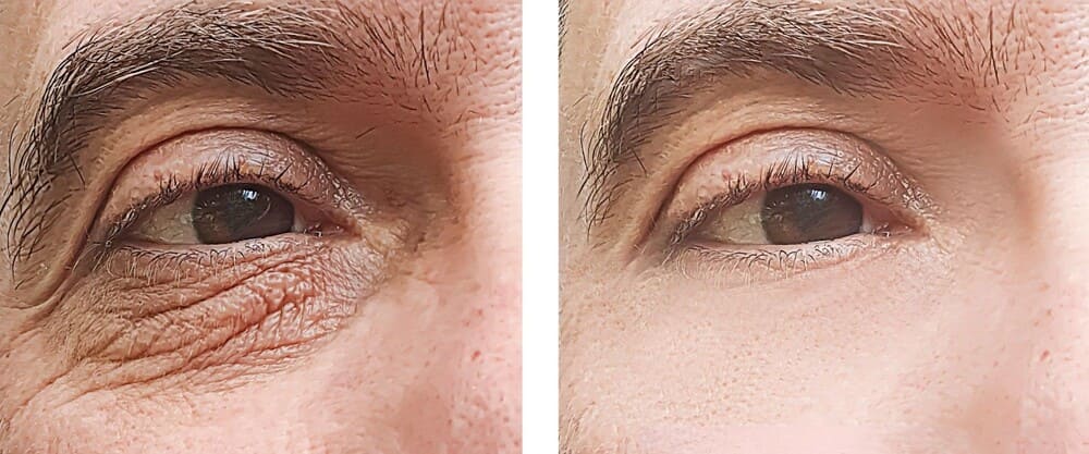 علاج التجاعيد بدون جراحة