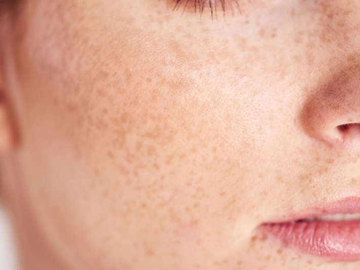 علاج النمش في الوجه