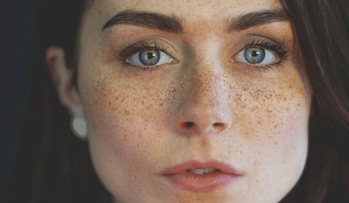 علاج النمش في الوجه