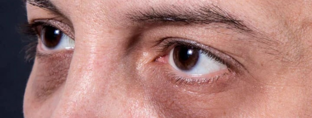 علاج الهالات السوداء تحت العين