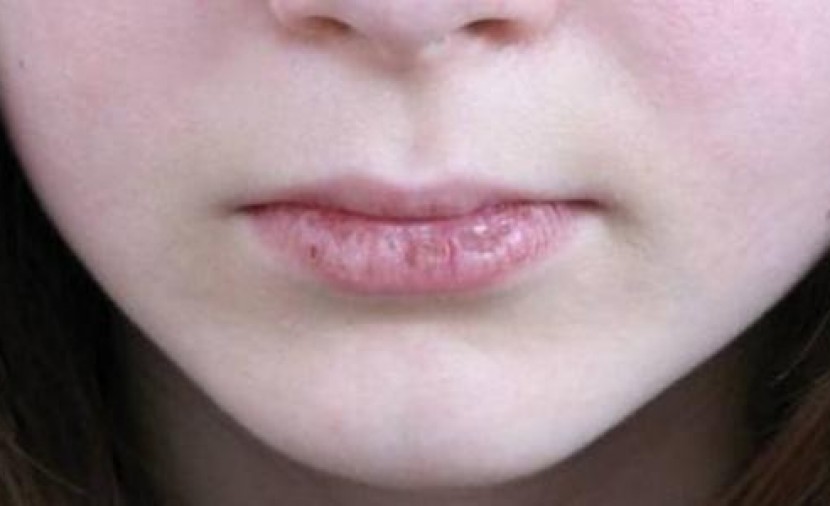 علاج تشقق الشفاه