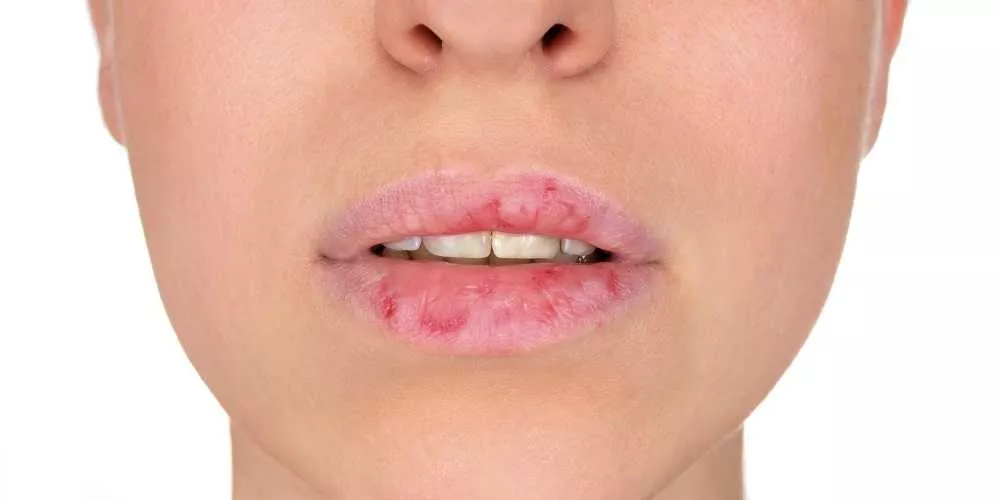 علاج تشقق الشفاه