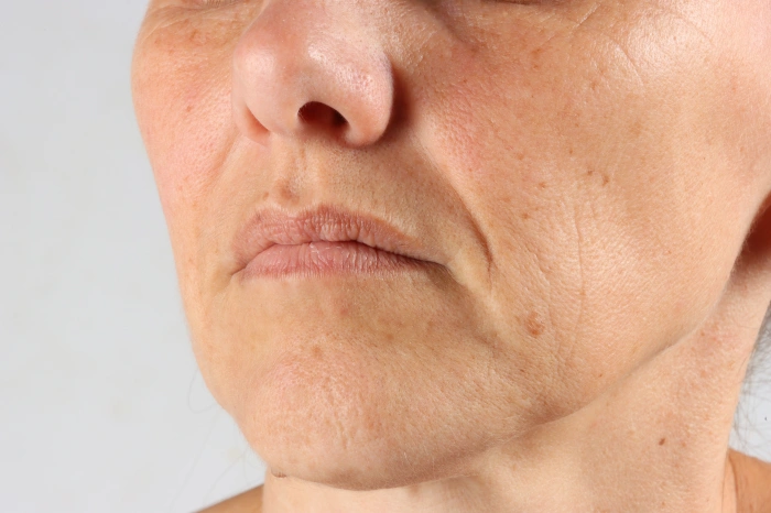 علاج خطوط الابتسامة