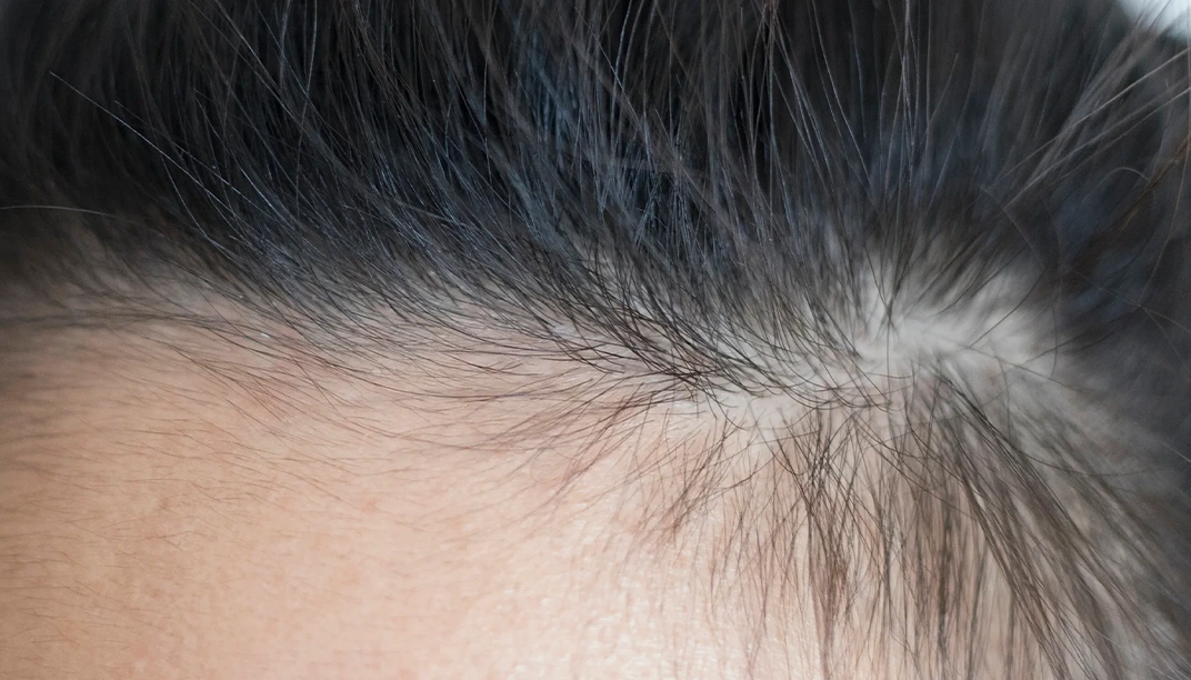 علاج ضعف بصيلات الشعر